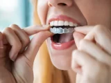 Care Tips For Invisalign Longevity