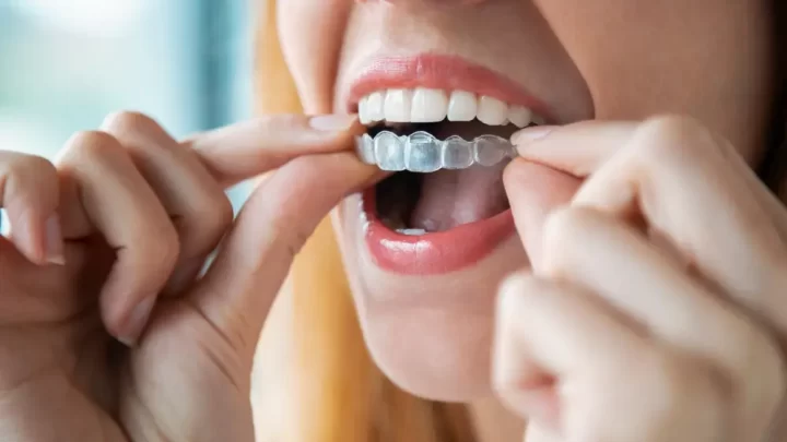 Care Tips For Invisalign Longevity